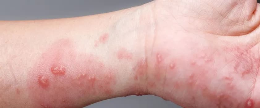 Jak pozbyć się świerzba z domu? Domowe metody i skuteczne porady